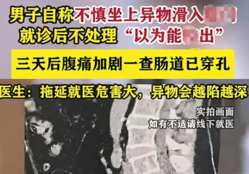 Medical Experts Warn Against Life-Threatening Risks of Rectal Foreign Bodies